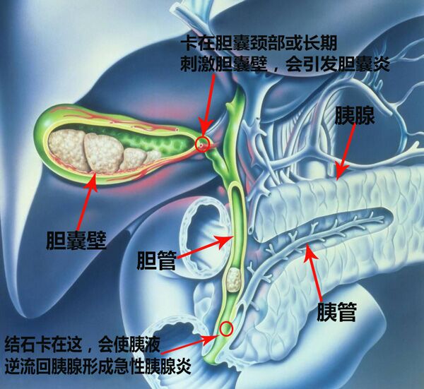 腹腔镜胆囊切除术适用无胆囊功能的患者